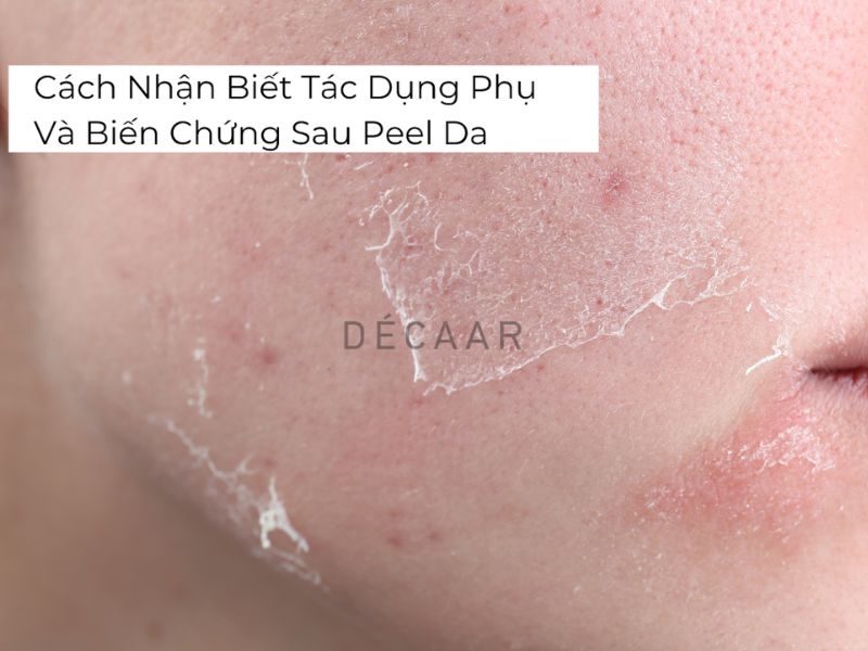 Tác dụng phụ và biến chứng sau peel da